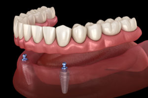 Implant Supported Denture Model, On 2 Dental Implants
