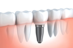 Dental Implant In Gumline Graphic
