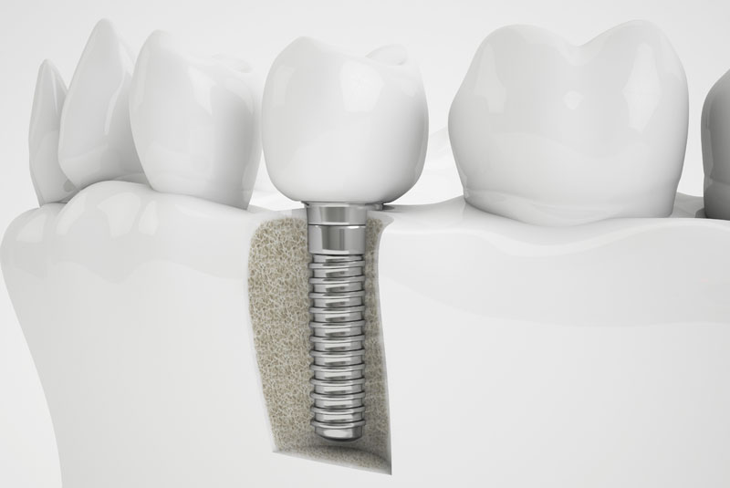 Bone Graft Around A Dental Implant