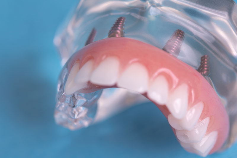 an image of a full mouth dental implant model with four dental implants.