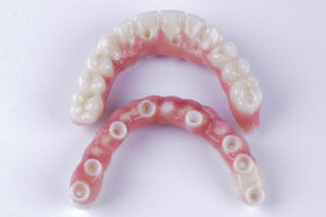 An image of zirconia full arch implants.