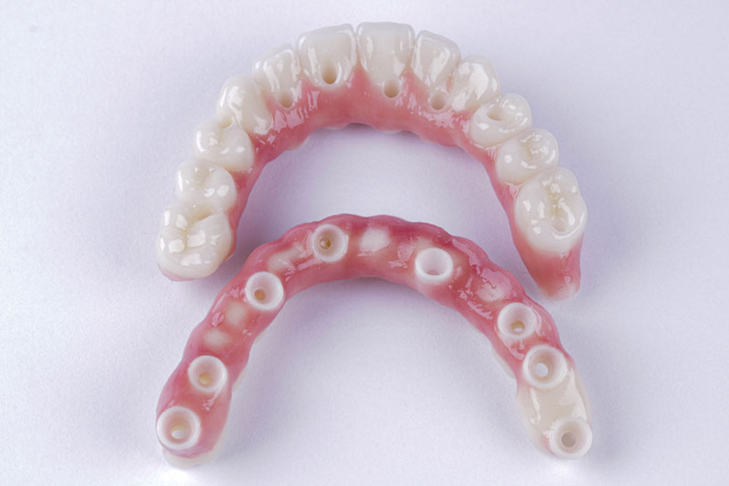 An image of zirconia full arch implants.