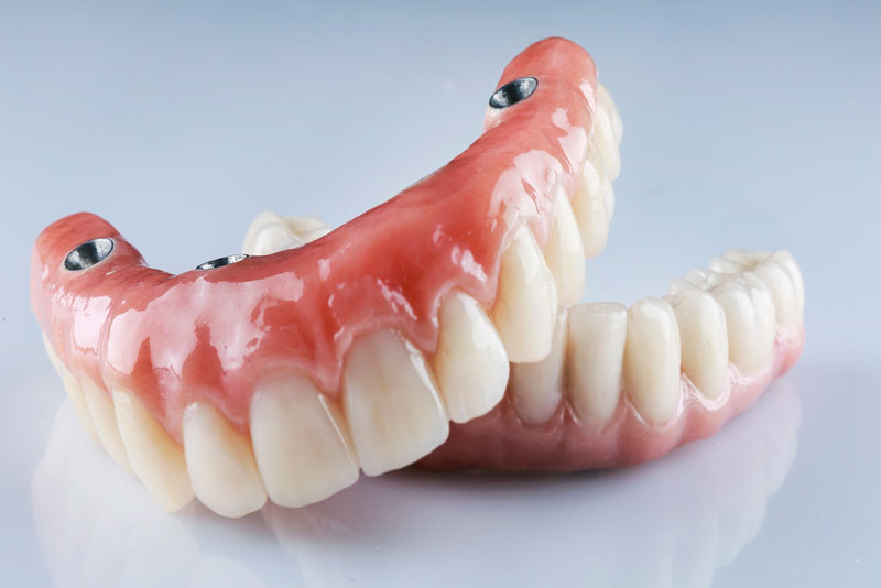 a set of full mouth dental implant models.